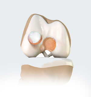 Cartilage Restoration of The PF Joint