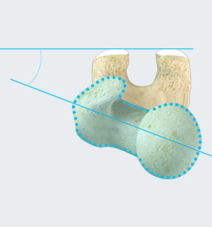 Derotational Osteotomies