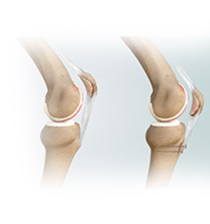 Distal Realignment Procedures