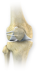 Medial Patellar Instability