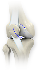 patellar Dislocations