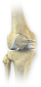 Lateral Patellar Instability