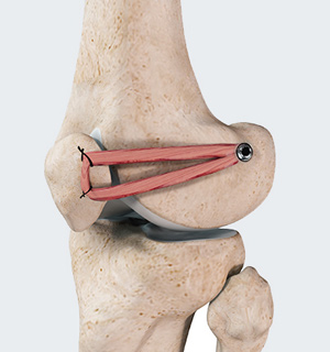 Patellofemoral Knee Replacement