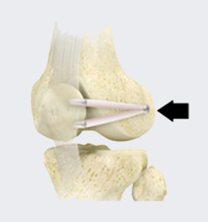 Soft Tissue Stabilization