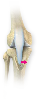 Tibial Tubercle Osteotomies