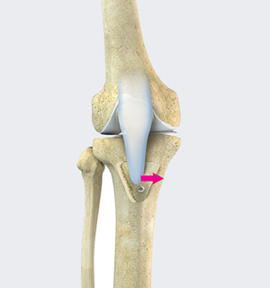 Tibial Tubercle Osteotomies