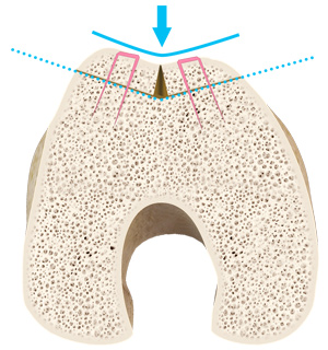 Trochleoplasty