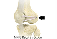 Soft Tissue Stabilization (MPFL Reconstruction)